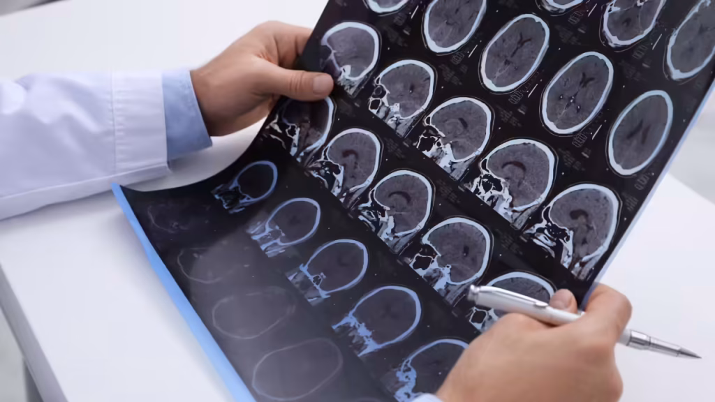 TOI_multiple-sclerosis